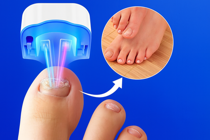 SingleBEAM™ – Präzise Laser-Therapie gegen Nagelpilz